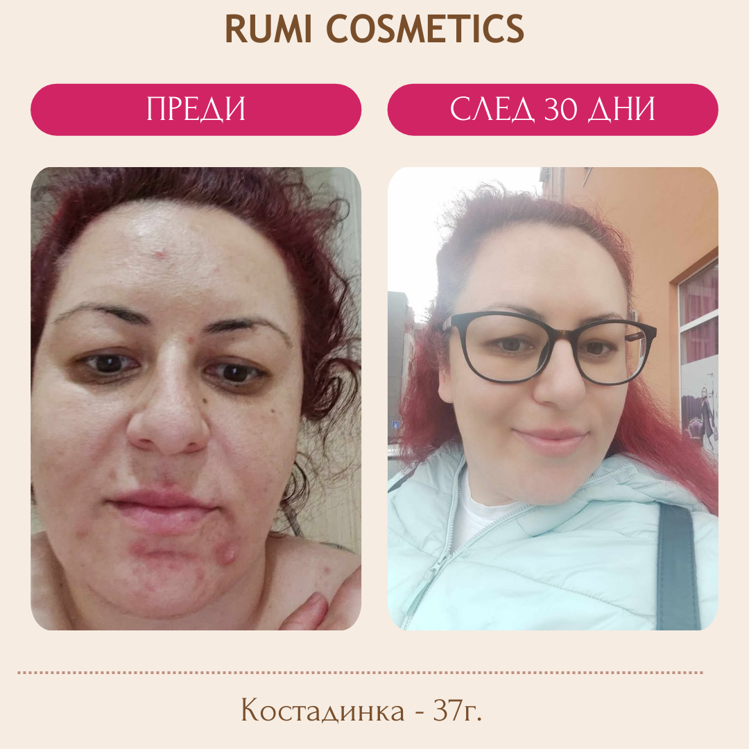 Комплект балсам, измивна пяна и крем за борба с акнето — продуктова снимка